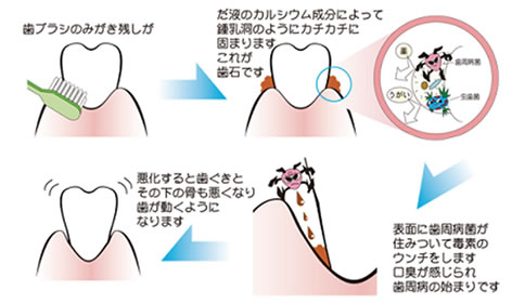 歯ブラシの磨き残しが歯周病の始まり