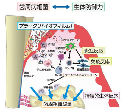 歯周病の発症・進行と生体反応