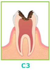 (C3)・重度のむし歯