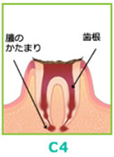 (C4)・末期のむし歯